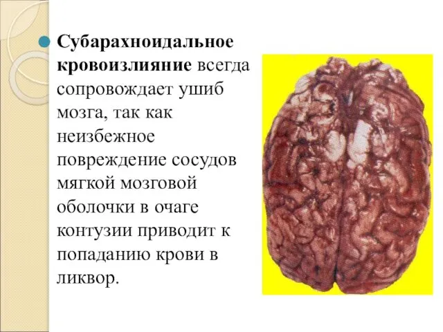 Субарахноидальное кровоизлияние всегда сопровождает ушиб мозга, так как неизбежное повреждение сосудов