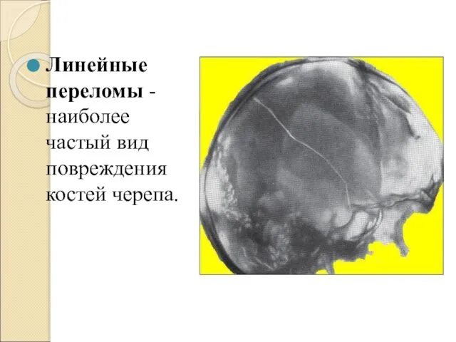 Линейные переломы - наиболее частый вид повреждения костей черепа.