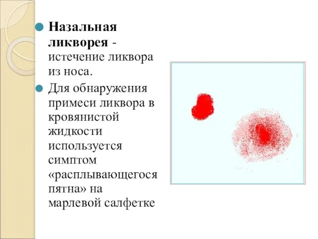 Назальная ликворея - истечение ликвора из носа. Для обнаружения примеси ликвора