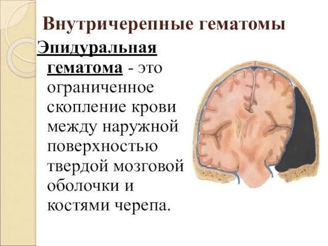 Внутричерепные гематомы Эпидуральная гематома - это ограниченное скопление крови между наружной