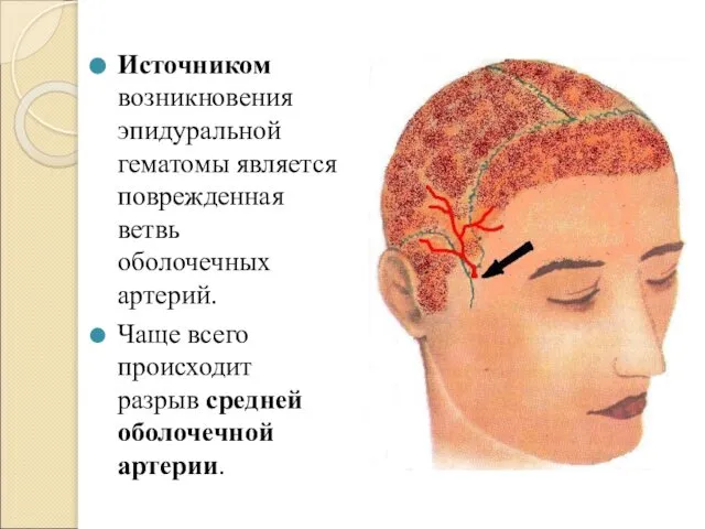 Источником возникновения эпидуральной гематомы является поврежденная ветвь оболочечных артерий. Чаще всего происходит разрыв средней оболочечной артерии.