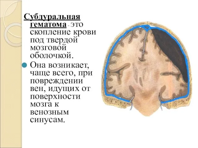 Субдуральная гематома - это скопление крови под твердой мозговой оболочкой. Она