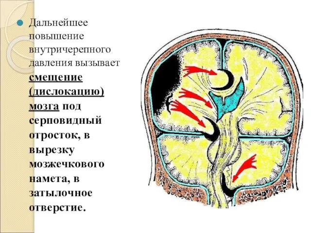 Дальнейшее повышение внутричерепного давления вызывает смещение (дислокацию) мозга под серповидный отросток,