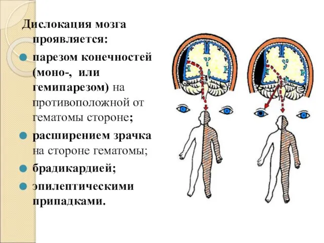 Дислокация мозга проявляется: парезом конечностей (моно-, или гемипарезом) на противоположной от