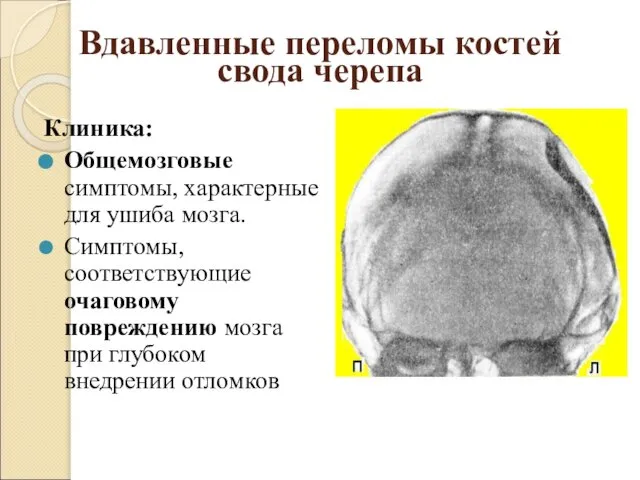 Вдавленные переломы костей свода черепа Клиника: Общемозговые симптомы, характерные для ушиба