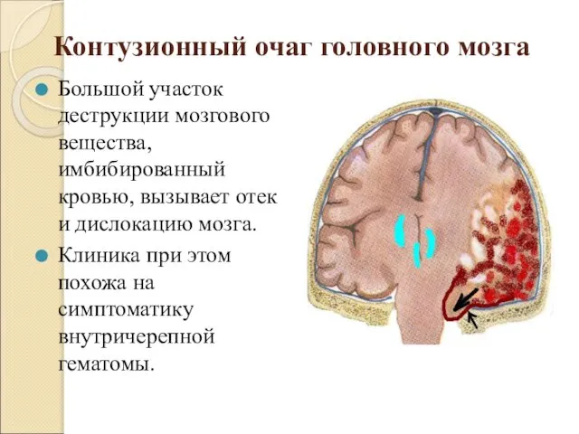 Контузионный очаг головного мозга Большой участок деструкции мозгового вещества, имбибированный кровью,