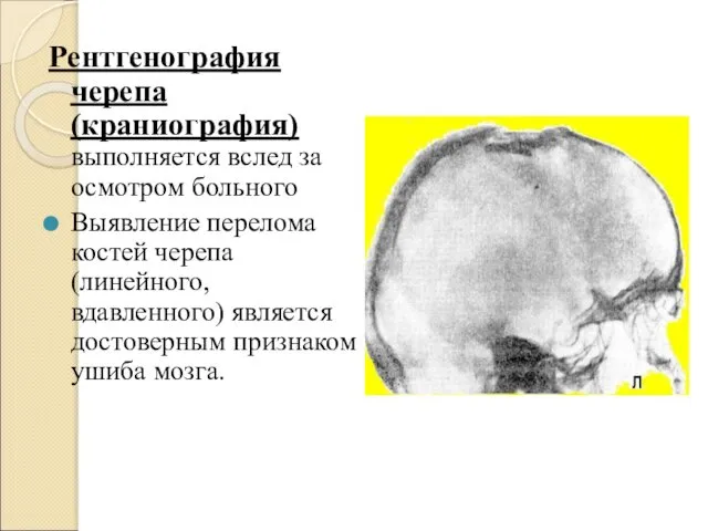 Рентгенография черепа (краниография) выполняется вслед за осмотром больного Выявление перелома костей