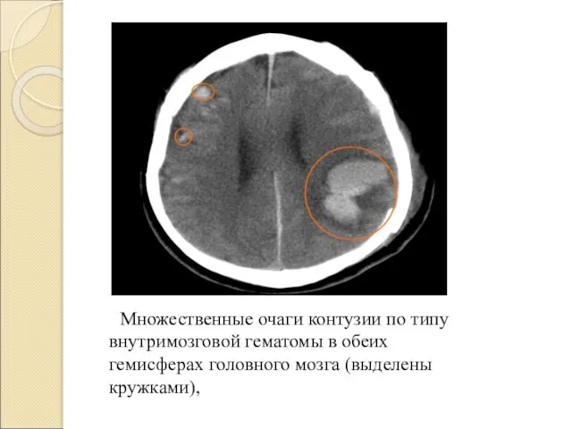 Множественные очаги контузии по типу внутримозговой гематомы в обеих гемисферах головного мозга (выделены кружками),