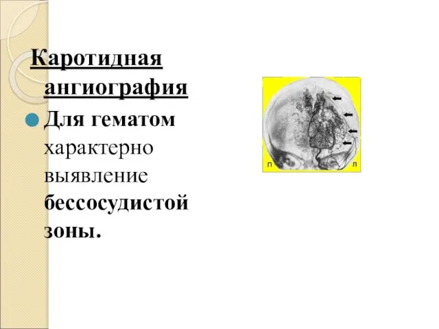 Каротидная ангиография Для гематом характерно выявление бессосудистой зоны.