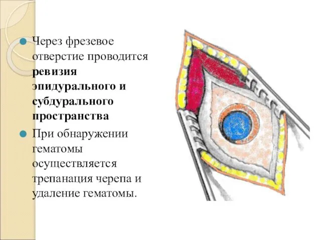 Через фрезевое отверстие проводится ревизия эпидурального и субдурального пространства При обнаружении