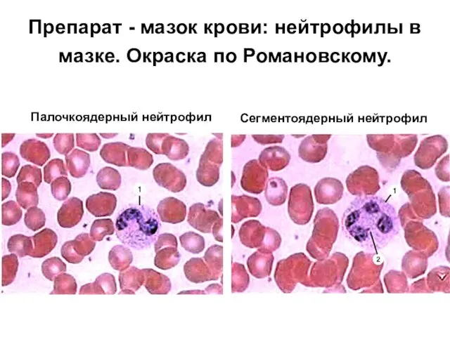 Препарат - мазок крови: нейтрофилы в мазке. Окраска по Романовскому. Сегментоядерный нейтрофил Палочкоядерный нейтрофил