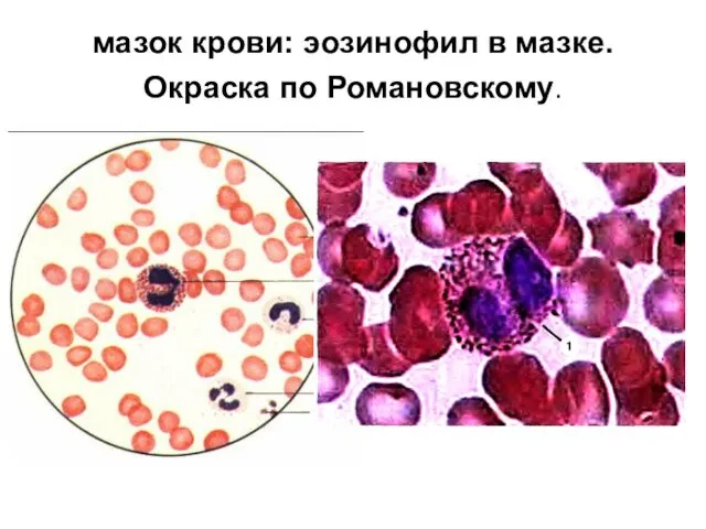 мазок крови: эозинофил в мазке. Окраска по Романовскому.