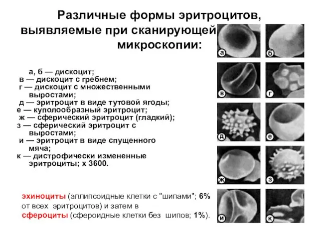 Различные формы эритроцитов, выявляемые при сканирующей электронной микроскопии: а, б —