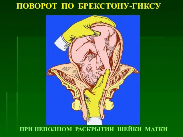 ПОВОРОТ ПО БРЕКСТОНУ-ГИКСУ ПРИ НЕПОЛНОМ РАСКРЫТИИ ШЕЙКИ МАТКИ