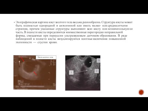 Эхографическая картина кист желтого тела весьма разнообразна. Структура кисты может быть