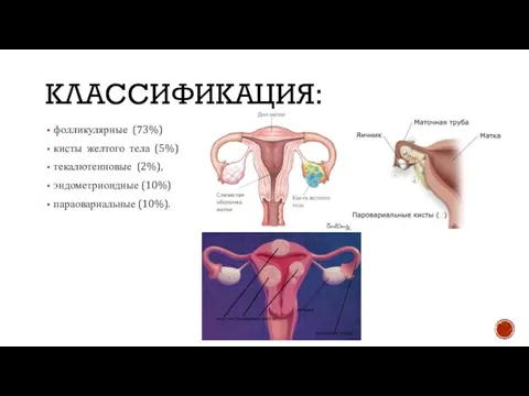 КЛАССИФИКАЦИЯ: фолликулярные (73%) кисты желтого тела (5%) текалютеиновые (2%), эндометриоидные (10%) параовариальные (10%).