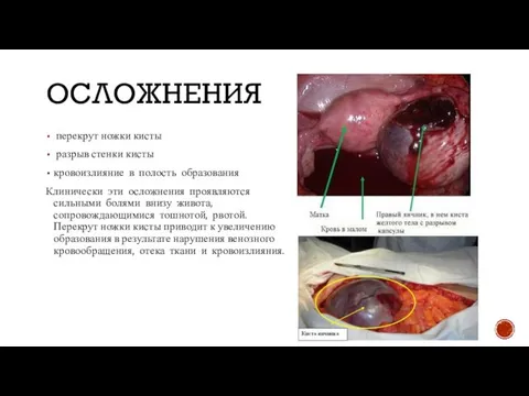 ОСЛОЖНЕНИЯ перекрут ножки кисты разрыв стенки кисты кровоизлияние в полость образования