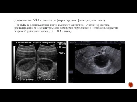 Динамическое УЗИ позволяет дифференцировать фолликулярную кисту При ЦДК в фолликулярной кисте