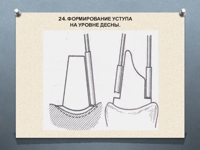 24. ФОРМИРОВАНИЕ УСТУПА НА УРОВНЕ ДЕСНЫ.