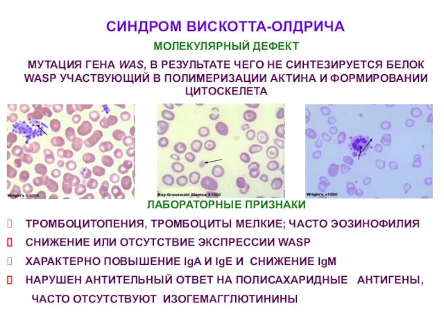 СИНДРОМ ВИСКОТТА-ОЛДРИЧА МОЛЕКУЛЯРНЫЙ ДЕФЕКТ МУТАЦИЯ ГЕНА WAS, В РЕЗУЛЬТАТЕ ЧЕГО НЕ