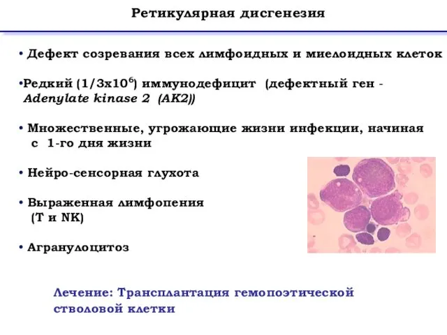 Ретикулярная дисгенезия Лечение: Трансплантация гемопоэтической стволовой клетки