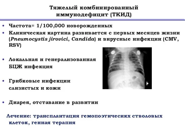 Частота= 1/100,000 новорожденных Клиническая картина развивается с первых месяцев жизни (Pneumocystis