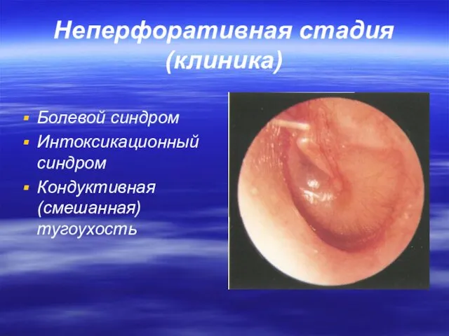 Неперфоративная стадия (клиника) Болевой синдром Интоксикационный синдром Кондуктивная (смешанная) тугоухость