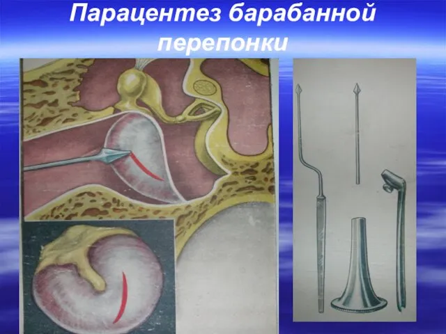 Парацентез барабанной перепонки