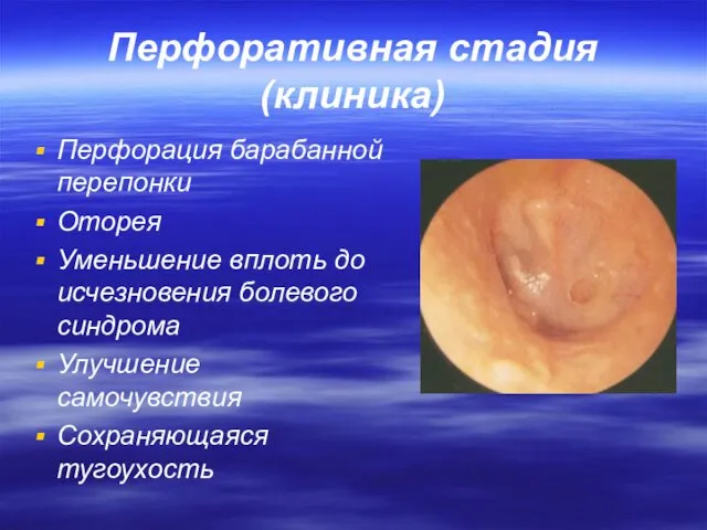 Перфоративная стадия (клиника) Перфорация барабанной перепонки Оторея Уменьшение вплоть до исчезновения