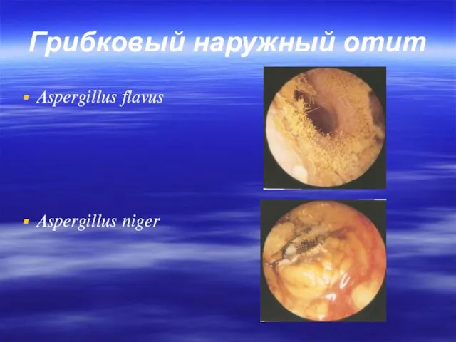 Грибковый наружный отит Aspergillus flavus Aspergillus niger