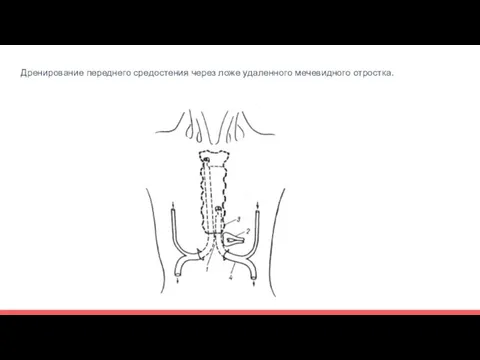 Дренирование переднего средостения через ложе удаленного мечевидного отростка.