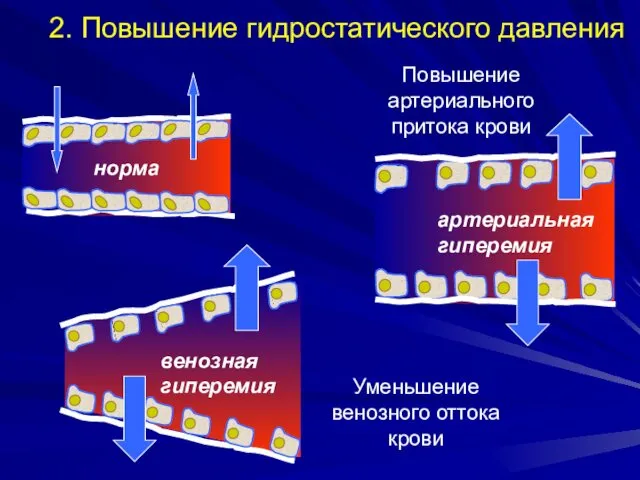 2. Повышение гидростатического давления Повышение артериального притока крови Уменьшение венозного оттока крови