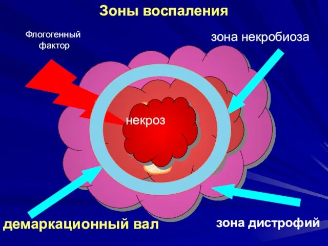 Флогогенный фактор Зоны воспаления некроз зона некробиоза зона дистрофий демаркационный вал