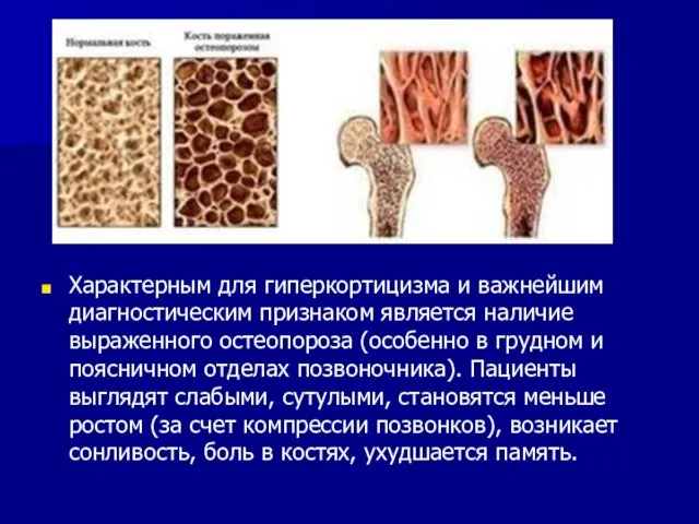 Характерным для гиперкортицизма и важнейшим диагностическим признаком является наличие выраженного остеопороза