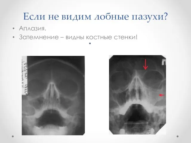 Если не видим лобные пазухи? Аплазия. Затемнение – видны костные стенки!