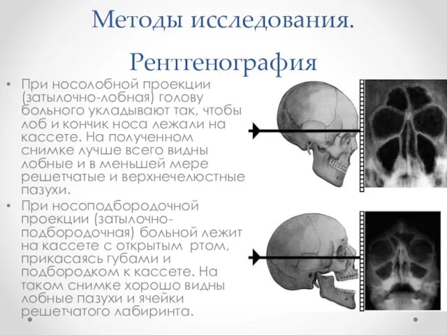 Методы исследования. Рентгенография При носолобной проекции (затылочно-лобная) голову больного укладывают так,