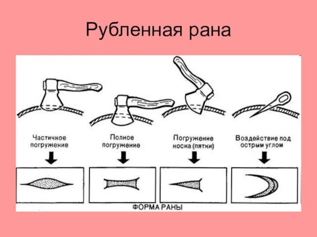 Рубленная рана