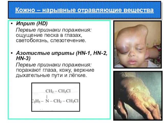 Кожно – нарывные отравляющие вещества Иприт (HD) Первые признаки поражения: ощущение