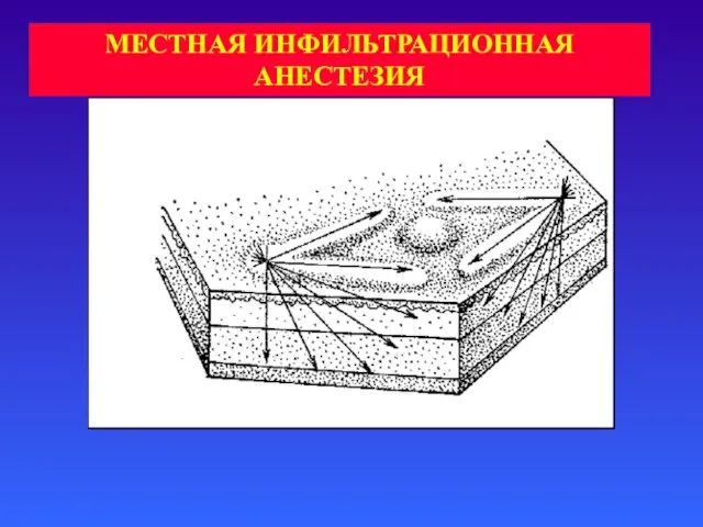 МЕСТНАЯ ИНФИЛЬТРАЦИОННАЯ АНЕСТЕЗИЯ