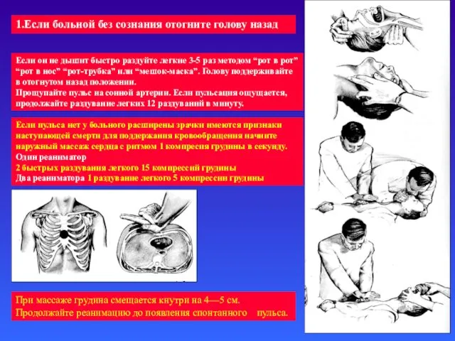1.Если больной без сознания отогните голову назад Если он не дышит