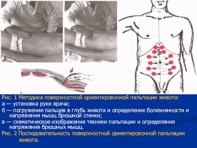 Рис. 1 Методика поверхностной ориентировочной пальпации живота: а — установка руки