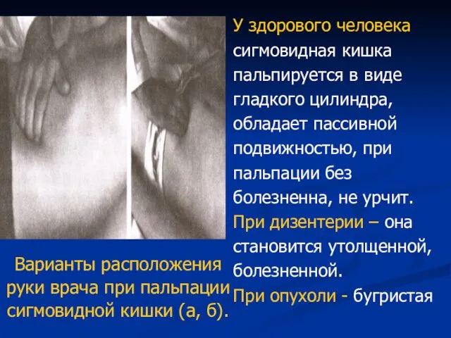 Варианты расположения руки врача при пальпации сигмовидной кишки (а, б). У