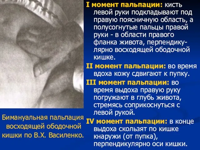 Бимануальная пальпация восходящей ободочной кишки по В.Х. Василенко. I момент пальпации: