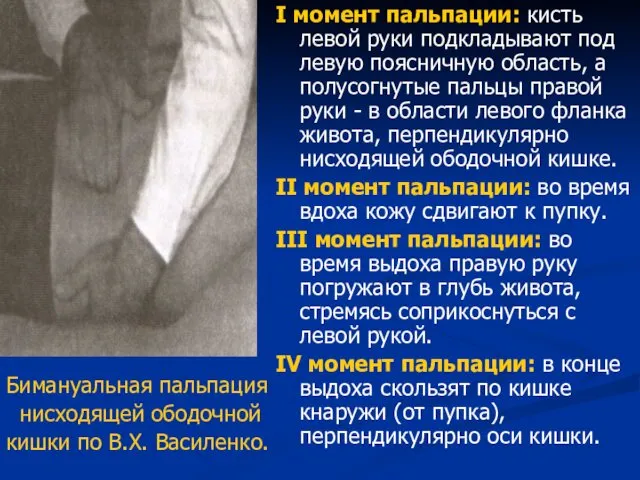 Бимануальная пальпация нисходящей ободочной кишки по В.Х. Василенко. I момент пальпации: