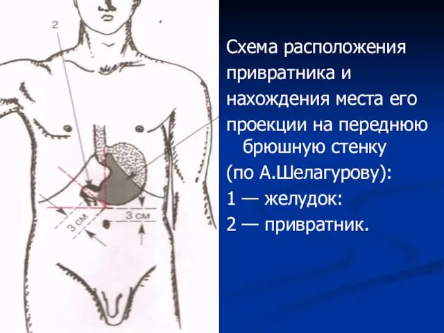 Схема расположения привратника и нахождения места его проекции на переднюю брюшную