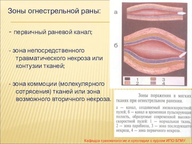 - первичный раневой канал; - зона непосредственного травматического некроза или контузии