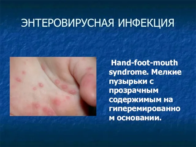 ЭНТЕРОВИРУСНАЯ ИНФЕКЦИЯ Hand-foot-mouth syndrome. Мелкие пузырьки с прозрачным содержимым на гиперемированном основании.