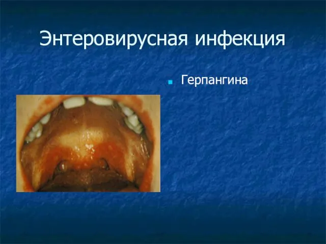 Энтеровирусная инфекция Герпангина