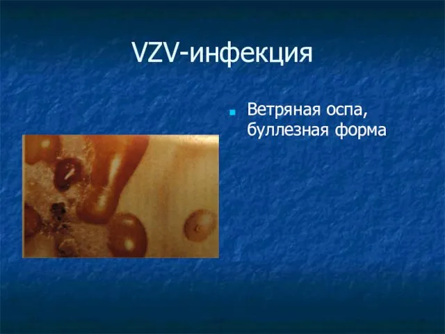 VZV-инфекция Ветряная оспа, буллезная форма