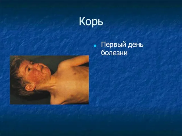 Корь Первый день болезни